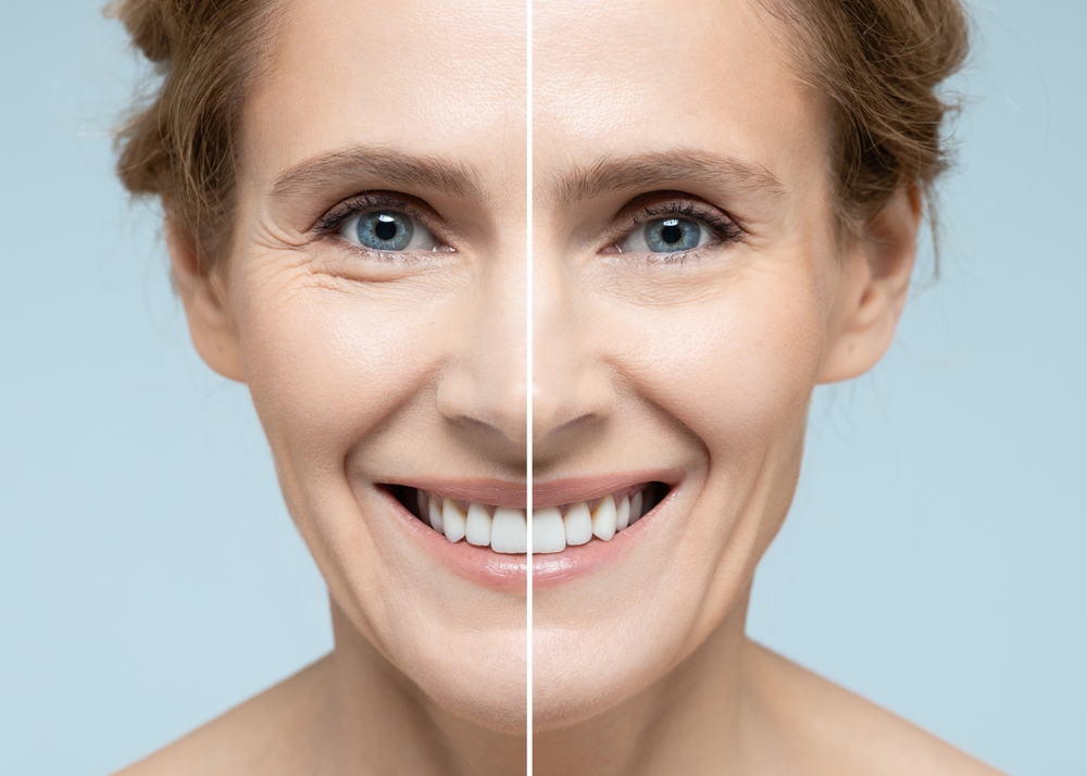 Woman's,Face,Before,And,After,Skin,Tightening,And,Anti-aging,Procedures.