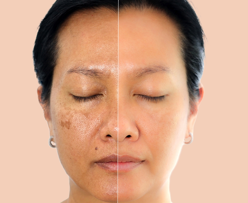 Retouched,Image,Before,And,After,Spot,Melasma,Pigmentation,Facial,Treatment