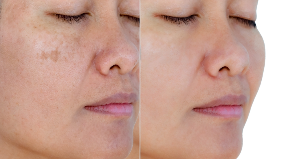 Image,Before,And,After,Spot,Melasma,Pigmentation,Facial,Treatment,On